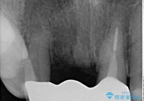 折れてしまった前歯 オールセラミックブリッジで自然な口元にの治療後