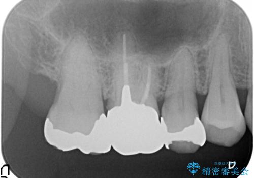 オールセラミッククラウン　銀歯と歯茎の隙間が気になるの治療前