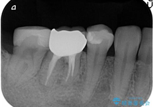 オールセラミッククラウン　他院にて抜歯を勧められた歯の治療の治療後