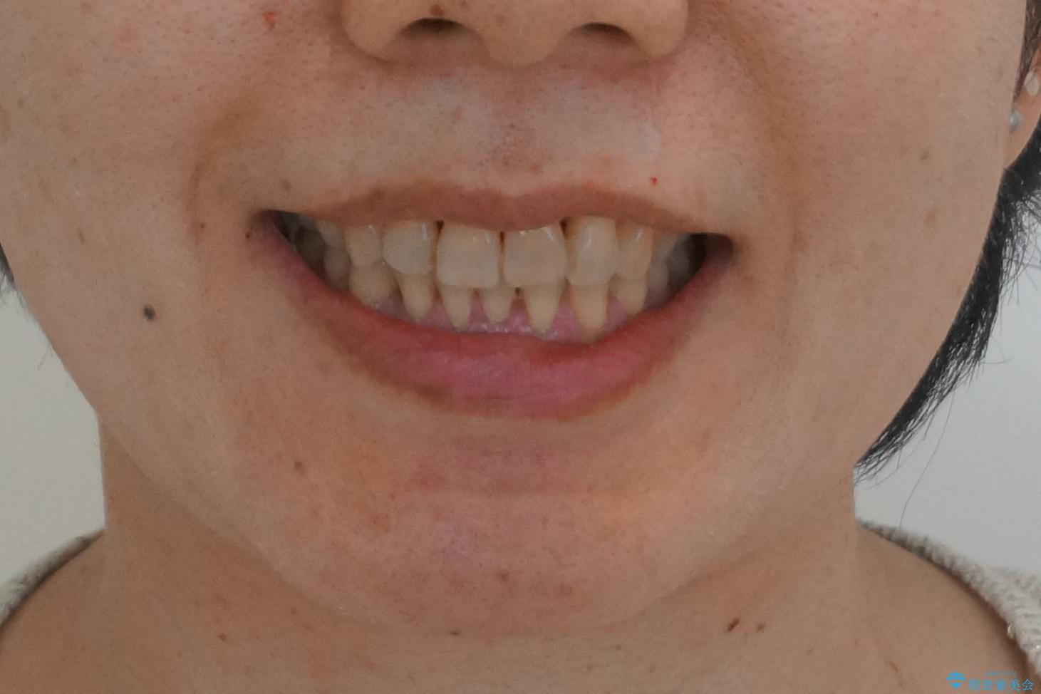 前歯のがたつき　インビザラインで抜歯矯正の治療後（顔貌）
