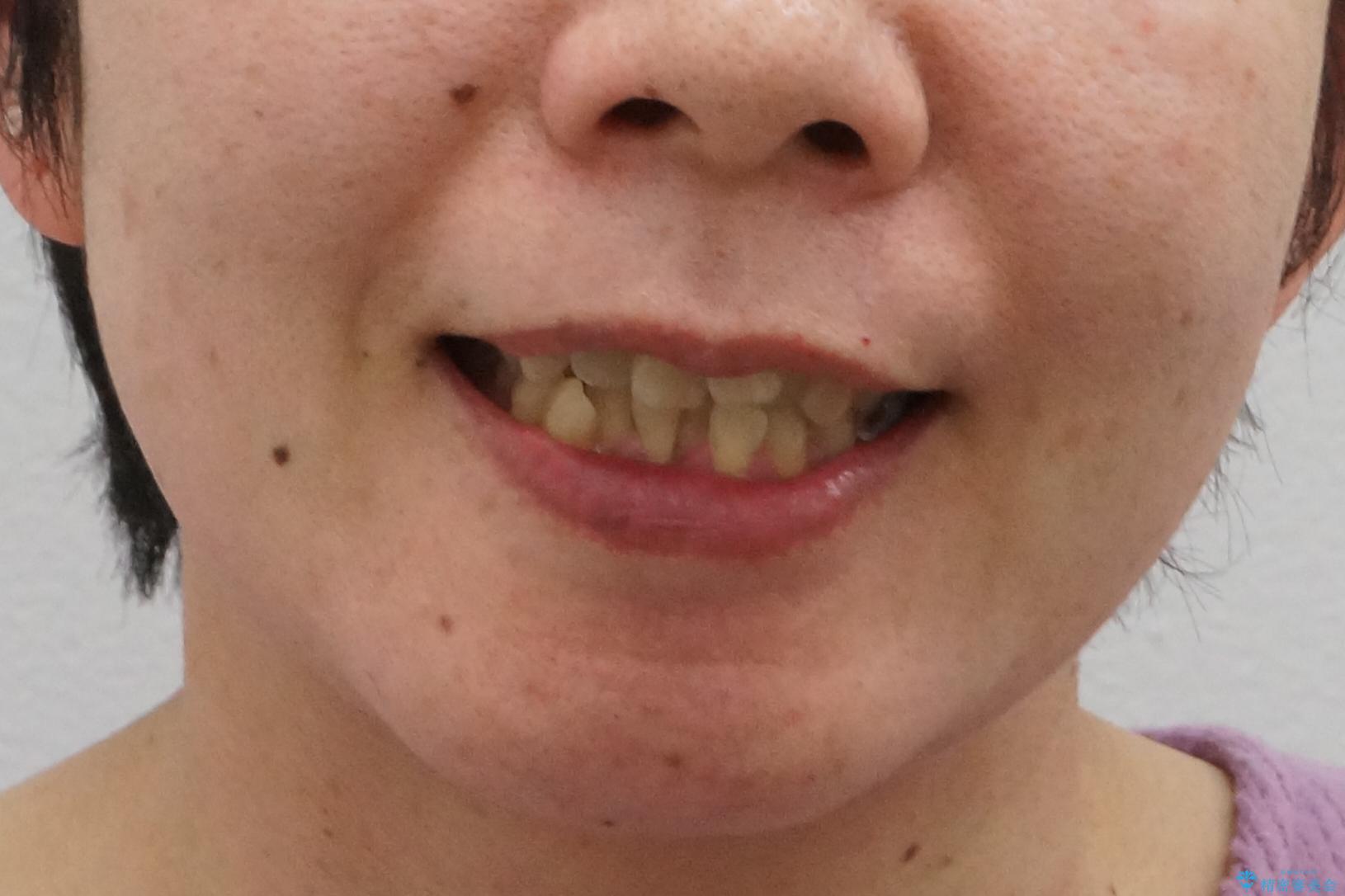 前歯のがたつき　インビザラインで抜歯矯正の治療前（顔貌）