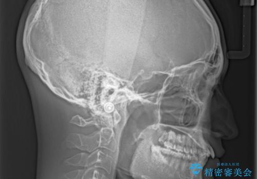 深い咬み合わせとデコボコ ワイヤー矯正で短期治療の治療前