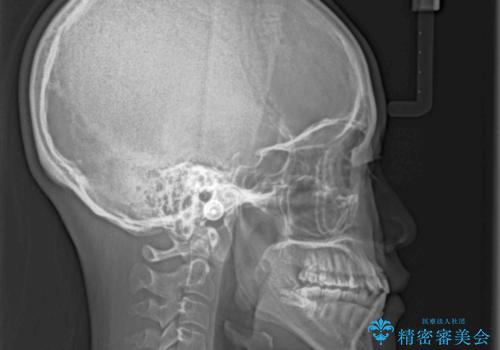 前歯のクロスバイトと変色した歯 ワイヤー矯正とセラミック治療の治療前