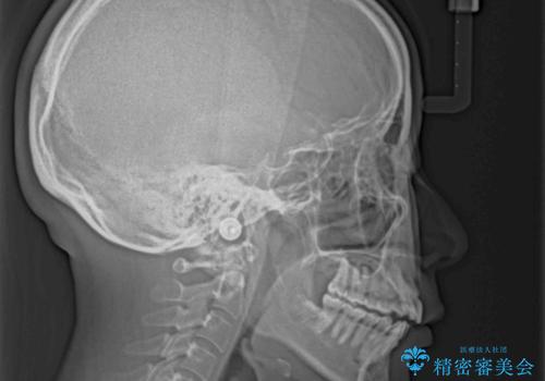 前歯のオープンバイトを治したい インビザラインでの矯正治療の治療前