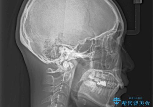 深い咬み合わせと奥歯のむし歯 総合歯科治療の治療前