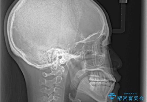前歯のクロスバイトと変色した歯 ワイヤー矯正とセラミック治療の治療後
