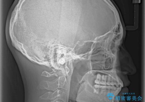 深い咬み合わせとデコボコ ワイヤー矯正で短期治療の治療後