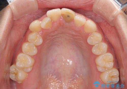 前歯のクロスバイトと変色した歯 ワイヤー矯正とセラミック治療の治療前