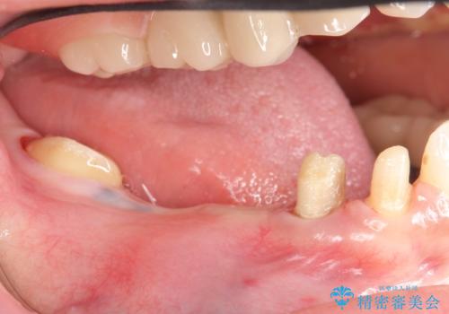 インプラント 抜歯になってしまった歯の補綴の治療前
