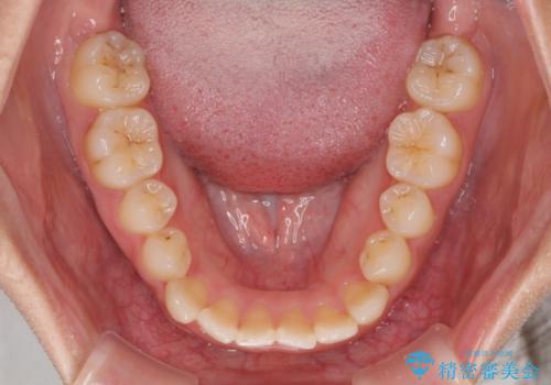 前歯のクロスバイトと変色した歯 ワイヤー矯正とセラミック治療の治療前