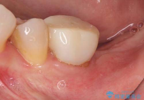 失った歯のインプラントでの咬合回復の症例 治療前