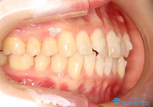 前歯のガタガタをインビザラインで目立たず矯正の治療中