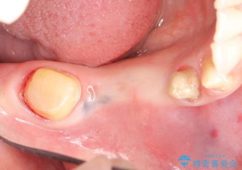 インプラント　抜歯になってしまった歯の補綴の治療前