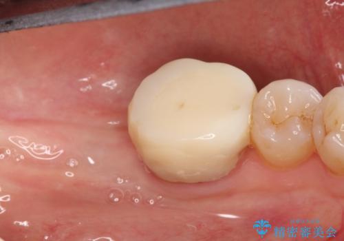 失った歯のインプラントでの咬合回復の治療前