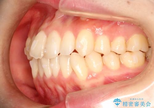 前歯のガタガタをインビザラインで目立たず矯正の治療中