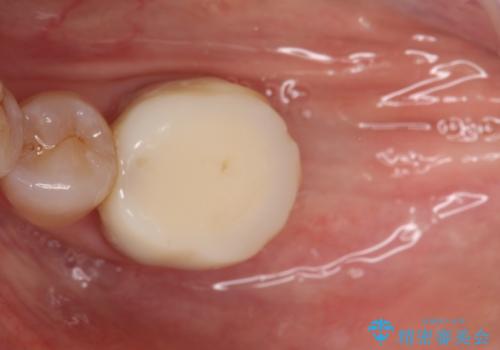 失った歯のインプラントでの咬合回復の治療前