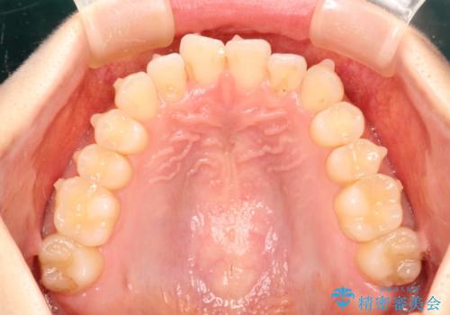 前歯のガタガタをインビザラインで目立たず矯正の治療中