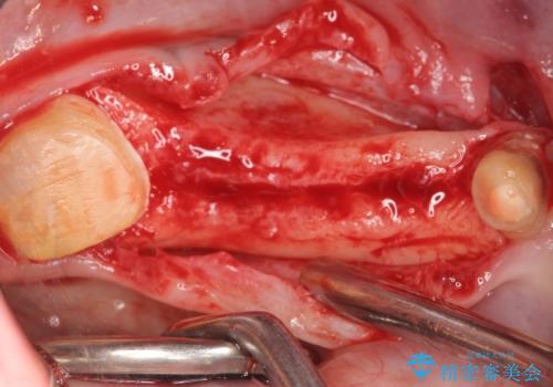 インプラント 抜歯になってしまった歯の補綴の治療中