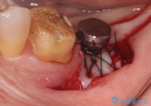 失った歯のインプラントでの咬合回復の治療中