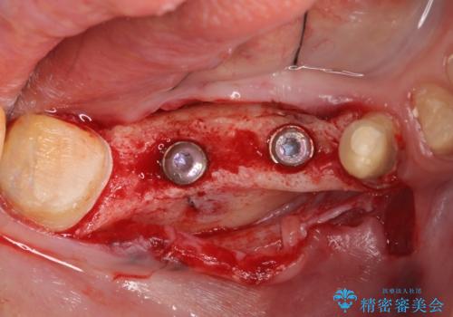 インプラント 抜歯になってしまった歯の補綴の治療中
