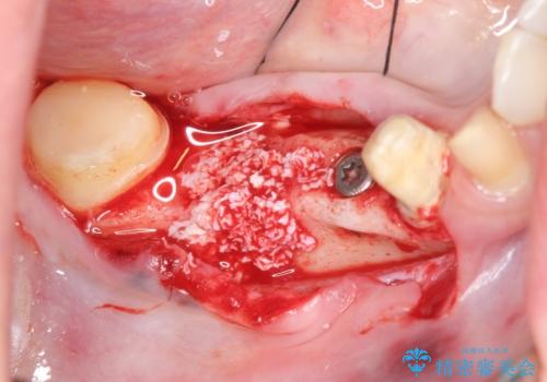 インプラント 抜歯になってしまった歯の補綴の治療中