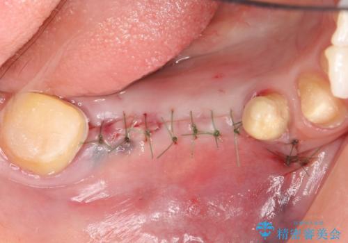 インプラント 抜歯になってしまった歯の補綴の治療後