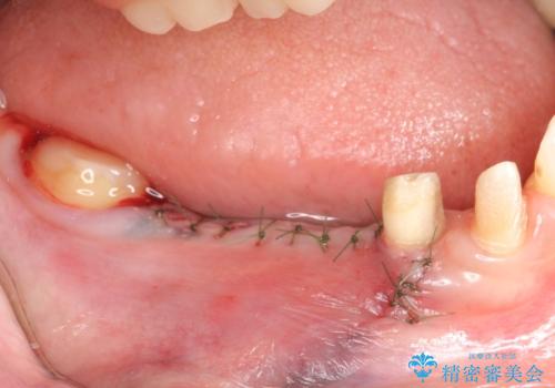 インプラント 抜歯になってしまった歯の補綴の治療後
