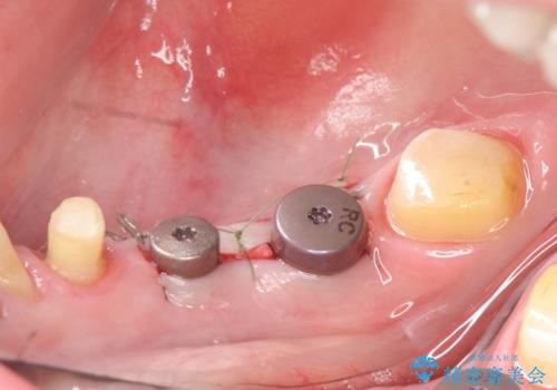 インプラント 抜歯になってしまった歯の補綴の治療後