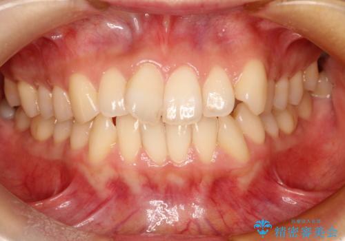 前歯のガタガタをインビザラインで目立たず矯正の治療前