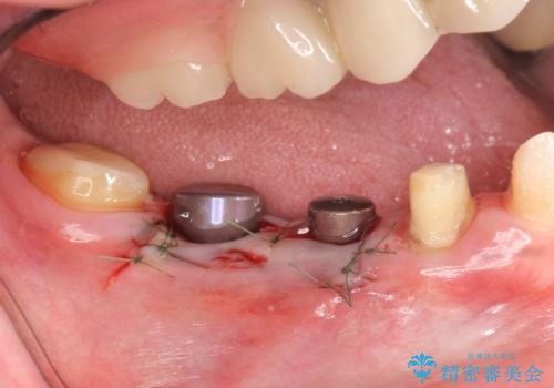 インプラント 抜歯になってしまった歯の補綴の治療後