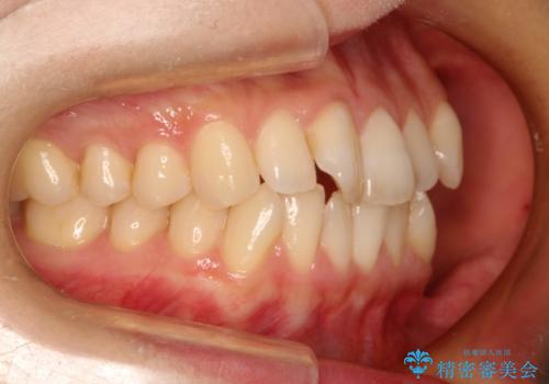 前歯のガタガタをインビザラインで目立たず矯正の症例 治療前