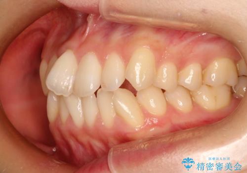 前歯のガタガタをインビザラインで目立たず矯正の治療前