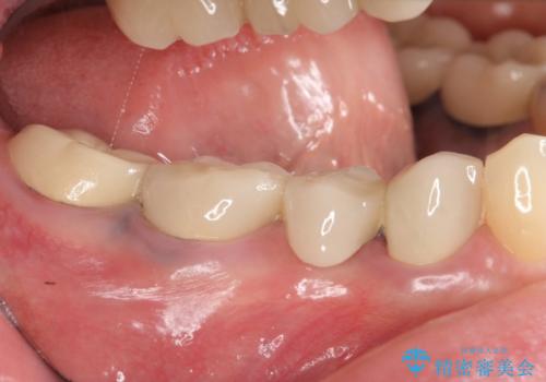 インプラント 抜歯になってしまった歯の補綴の治療前