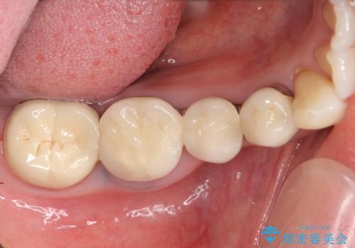 インプラント　抜歯になってしまった歯の補綴の症例 治療前