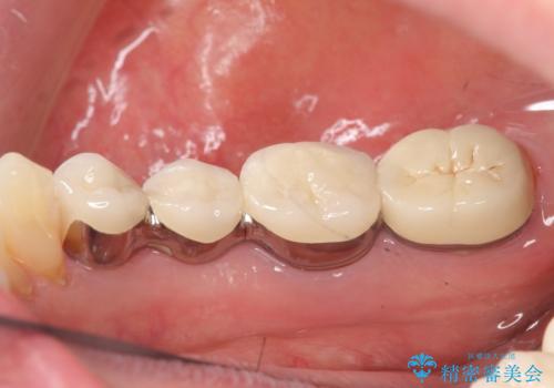 インプラント 抜歯になってしまった歯の補綴の治療前