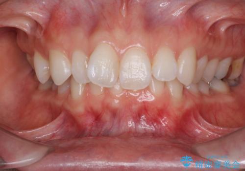 深い咬み合わせと奥歯のむし歯　総合歯科治療の症例 治療前