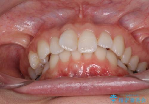 深い咬み合わせと奥歯のむし歯 総合歯科治療の治療前