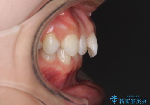 深い咬み合わせと奥歯のむし歯 総合歯科治療の治療前