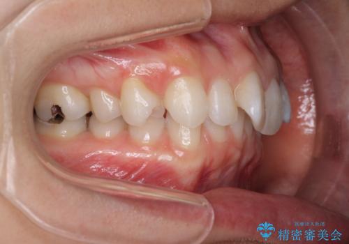 深い咬み合わせと奥歯のむし歯 総合歯科治療の治療前