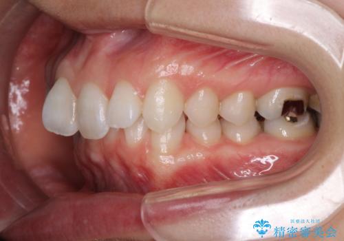 深い咬み合わせと奥歯のむし歯 総合歯科治療の治療前