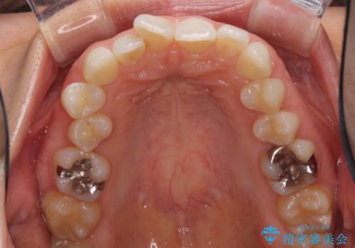 深い咬み合わせと奥歯のむし歯 総合歯科治療の治療前