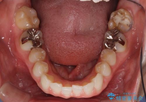 深い咬み合わせと奥歯のむし歯 総合歯科治療の治療前