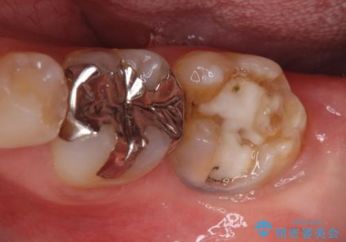 深い咬み合わせと奥歯のむし歯 総合歯科治療の治療前