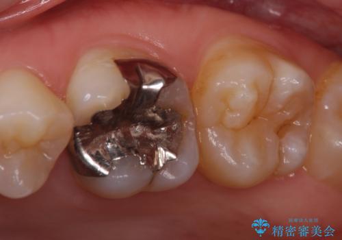 深い咬み合わせと奥歯のむし歯 総合歯科治療の治療前