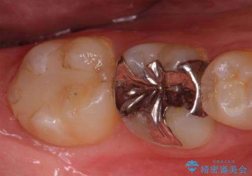深い咬み合わせと奥歯のむし歯　総合歯科治療の治療前