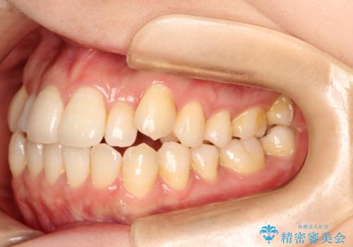 インビザラインで八重歯の矯正の治療前