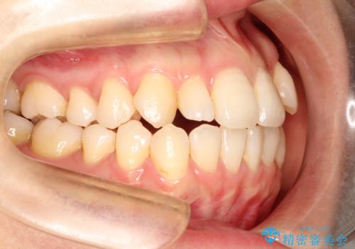 インビザラインで八重歯の矯正の治療前