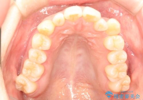 インビザラインで八重歯の矯正の治療前