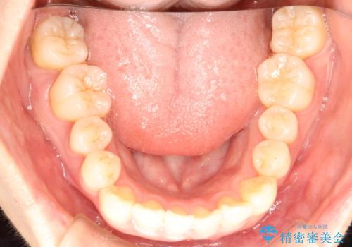 インビザラインで八重歯の矯正の治療前