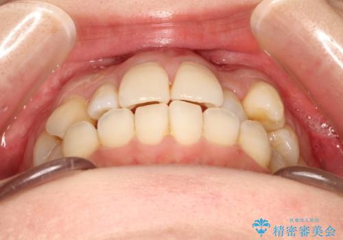 インビザラインで八重歯の矯正の治療前